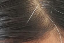 Mengapa Uban Muncul di Usia Muda? Kenali Penyebab dan Cara Mencegahnya