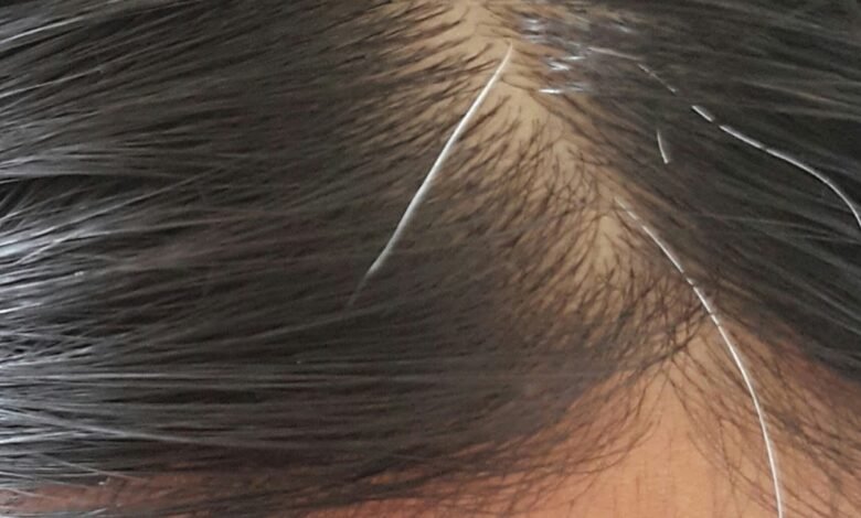 Mengapa Uban Muncul di Usia Muda? Kenali Penyebab dan Cara Mencegahnya